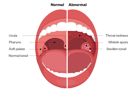 Strep Throat Symptoms Causes And Treatment Bee Healthy