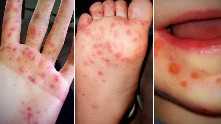 Risks Of Developing Hand Foot And Mouth Diseases Bee Healthy